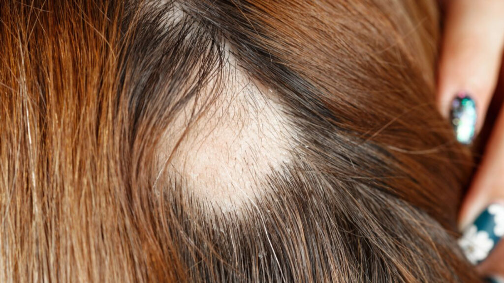 Close-up of a bald patch on a person's scalp.