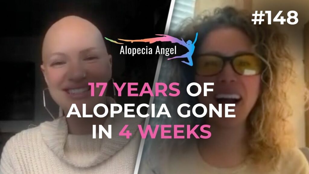 A happy person shows results of alopecia treatment after 4 weeks.