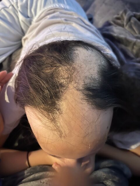 Person with significant hair loss on the top of their head.