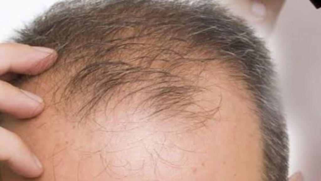 Close-up of a balding scalp with thinning hair.