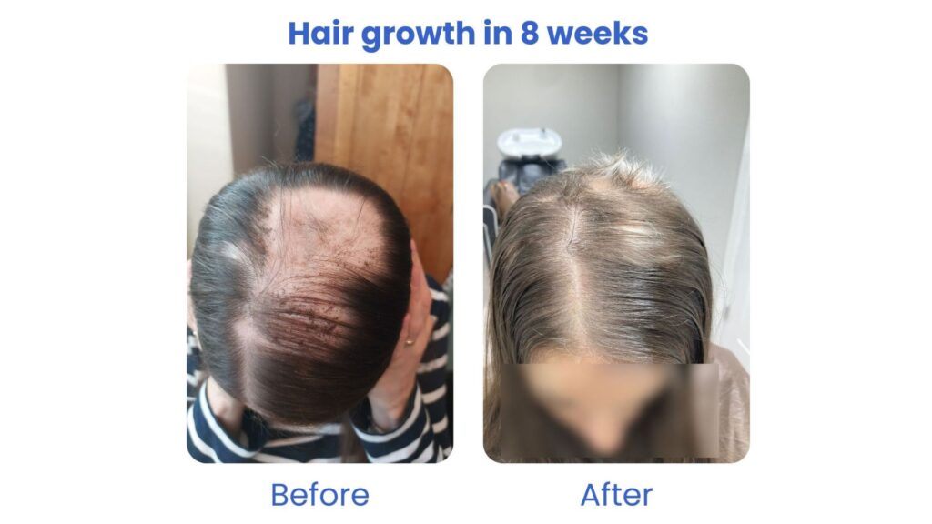 Before and after photos showing significant hair growth in 8 weeks.