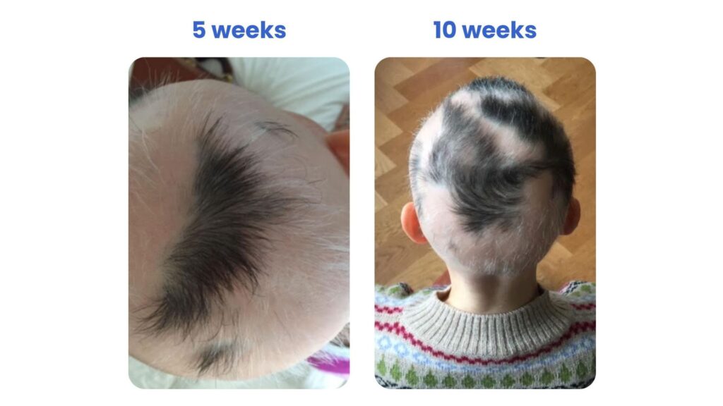 Hair growth progress from 5 to 10 weeks on a child's head.