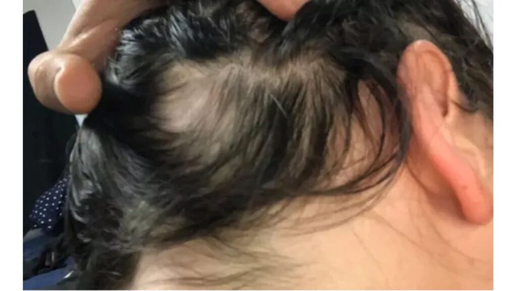 Close-up of a scalp with thinning hair and some hair loss.