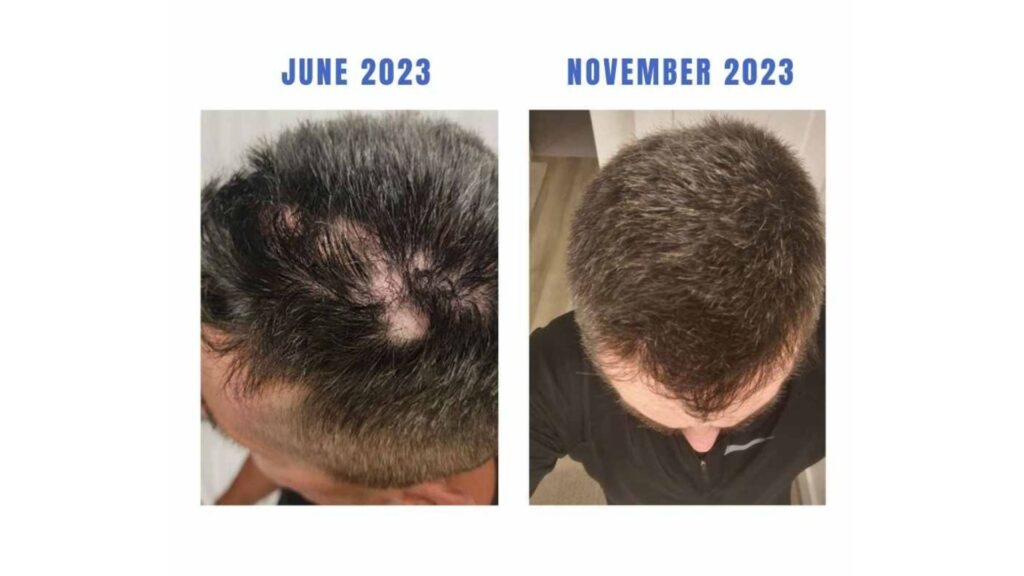 Comparison of hair growth from June 2023 to November 2023 showing significant improvement.