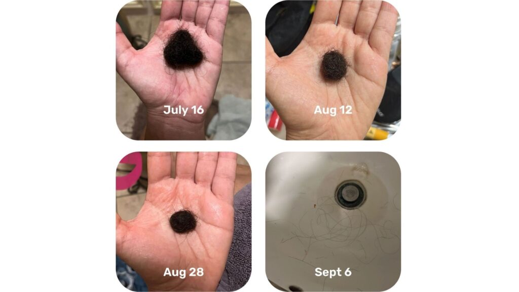 Progression of a black spot on a hand from July 16 to September 6.