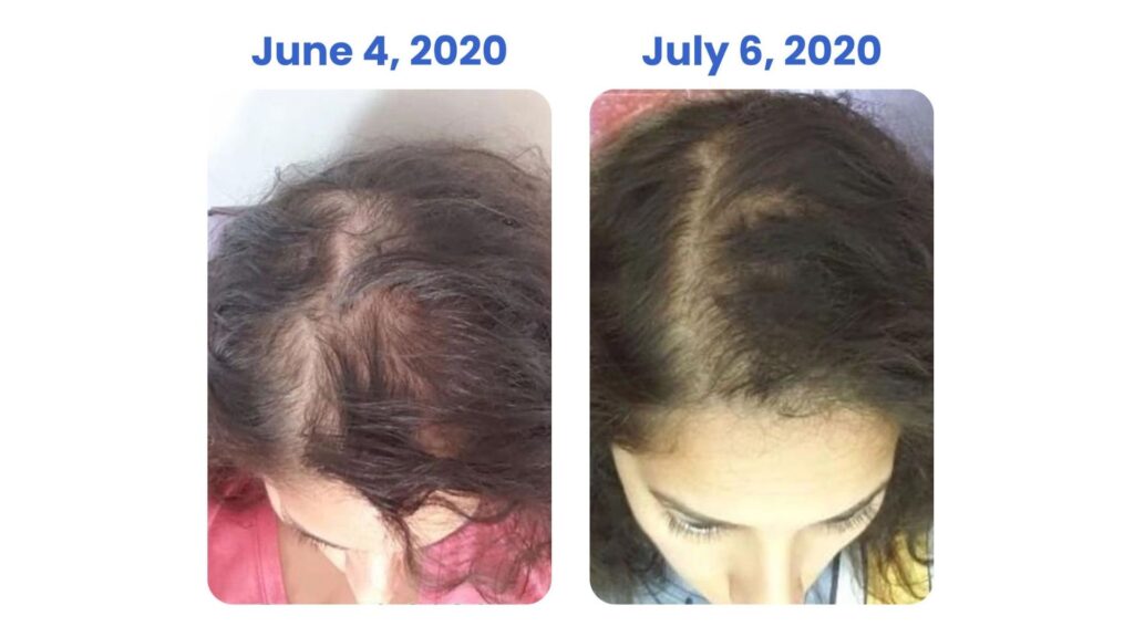 Comparison of hair growth over two months showing significant improvement.