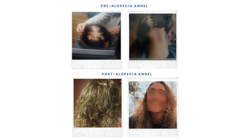 Before and after photos showing hair loss and regrowth.