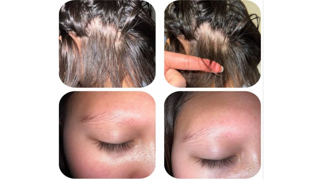 Before and after photos showing improvement in hair regrowth and eyebrow density.