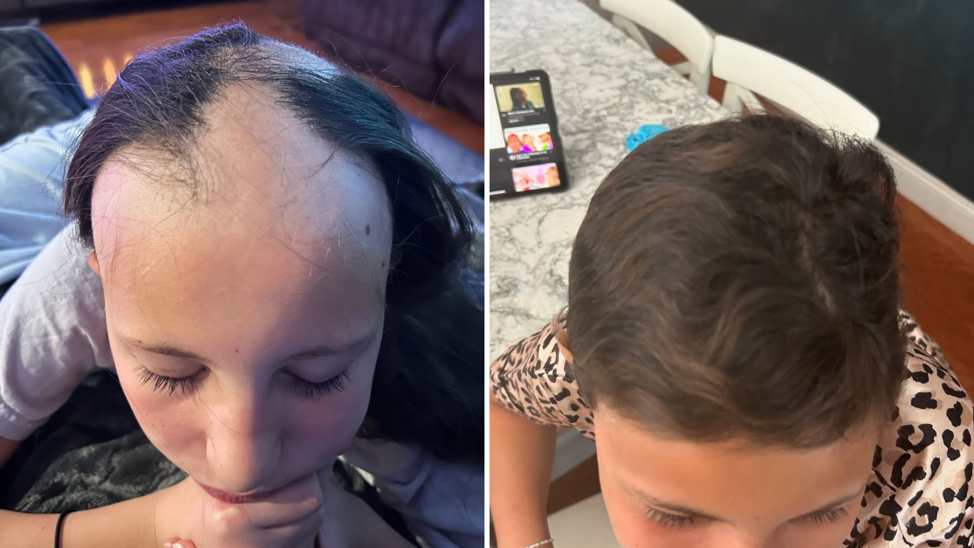 Side-by-side photos showing hair regrowth progress in a person.